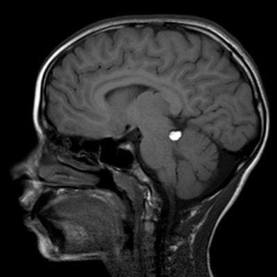 липома на МРТ головного мозга